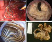 放进去的输尿管支架，还能轻松取出来吗？